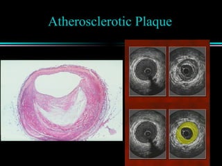Atherosclerotic Plaque
 