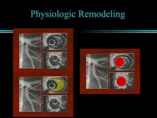 Physiologic Remodeling
 