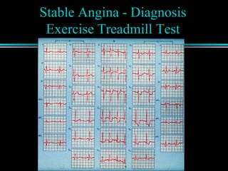 Stable Angina - Diagnosis
Exercise Treadmill Test
 