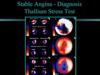 Stable Angina - Diagnosis
Thallium Stress Test
 