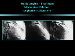 Stable Angina - Treatment
Mechanical Dilation:
Angioplasty, Stent, etc.
 