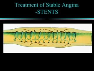 Treatment of Stable Angina
-STENTS
 