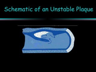 Schematic of an Unstable PlaqueSchematic of an Unstable Plaque
 
