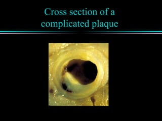 Cross section of a
complicated plaque
 