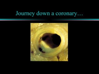 Journey down a coronary…
 