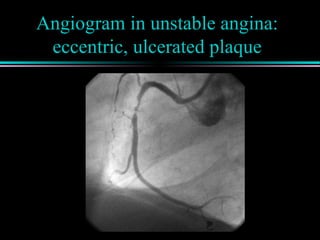 Angiogram in unstable angina:
eccentric, ulcerated plaque
 