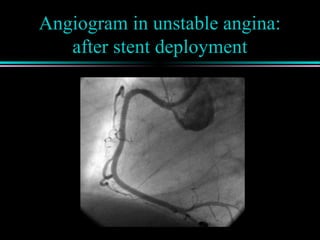 Angiogram in unstable angina:
after stent deployment
 