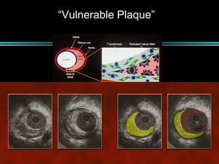 “Vulnerable Plaque”
 