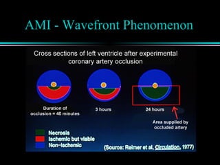 AMI - Wavefront Phenomenon
 