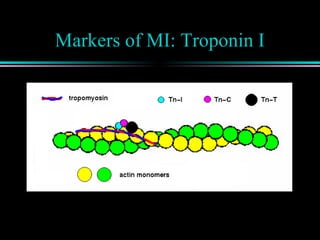Markers of MI: Troponin I
 