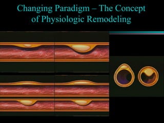 Changing Paradigm – The Concept
of Physiologic Remodeling
 
