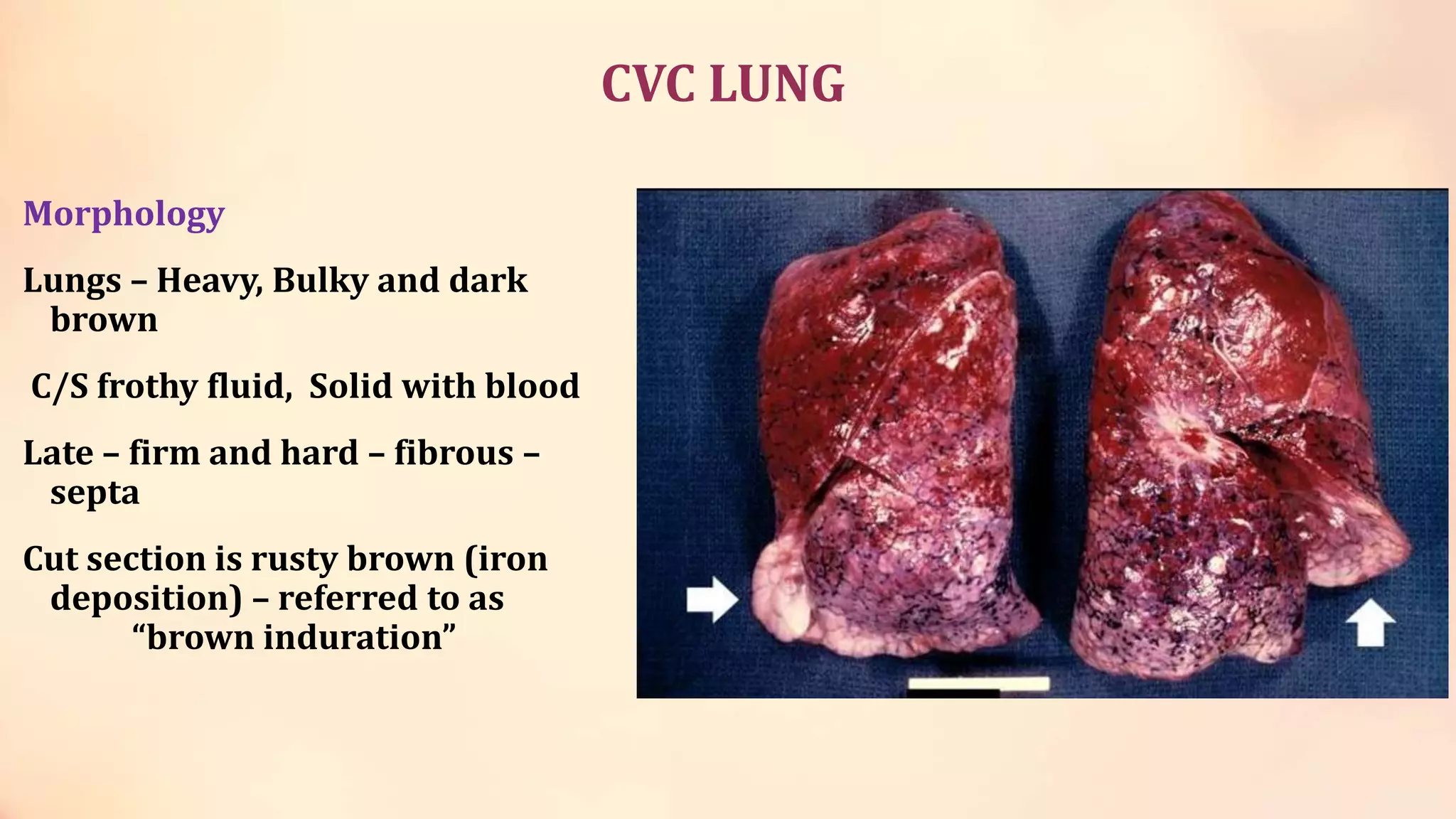 ischemia-and-infarction.ppt