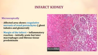 ischemia-and-infarction.ppt