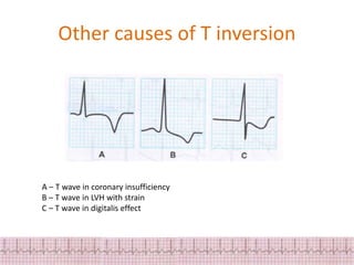 ECG changes in myocardial Ischemia and injury | PPTX