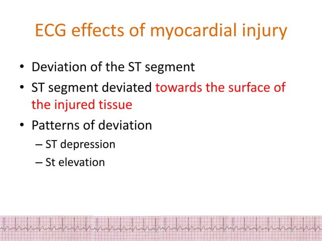 ECG changes in myocardial Ischemia and injury | PPTX | Heart and ...