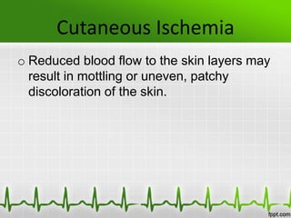 Cutaneous Ischemia
o Reduced blood flow to the skin layers may
result in mottling or uneven, patchy
discoloration of the skin.
 