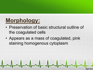 Morphology:
• Preservation of basic structural outline of
the coagulated cells
• Appears as a mass of coagulated, pink
staining homogenous cytoplasm
 