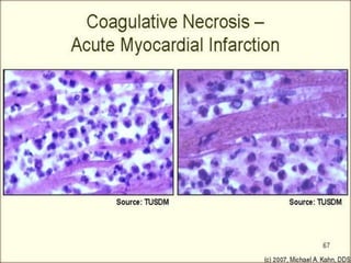 Coaglative necrosis:a wedge shaped kidney
infarct
 