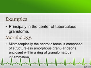 Examples
• Principaly in the center of tuberculous
granuloma.
Morphology:
• Microscopically the necrotic focus is composed
of structureless amorphous granular debris
enclosed within a ring of granulomatous
inflammation.
 