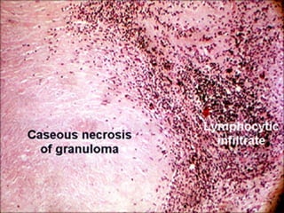 Caseous necrosis. Tuberculosis of the lung
 
