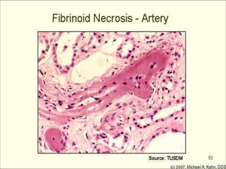 Fibrinoid necrosis in an artery
 