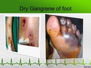 Dry Gangrene of foot
 