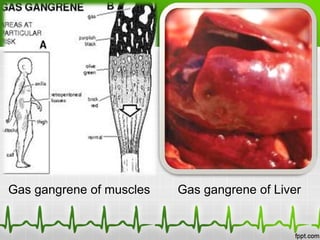 Gas gangrene of muscles Gas gangrene of Liver
 