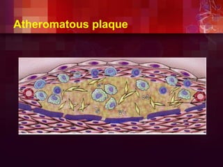 Atheromatous plaque
 