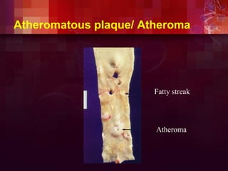 Atheromatous plaque/ Atheroma
Fatty streak
Atheroma
 
