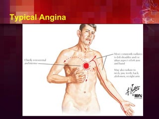 Typical Angina
 