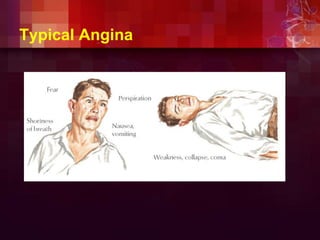 Typical Angina
 