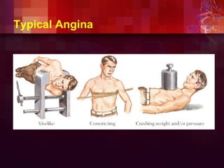 Typical Angina
 