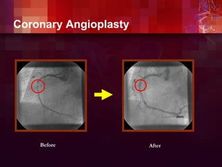Coronary Angioplasty
Before After
 
