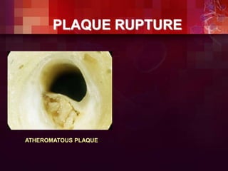 ATHEROMATOUS PLAQUE
PLAQUE RUPTURE
 