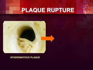 ATHEROMATOUS PLAQUE
PLAQUE RUPTURE
 