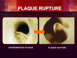 ATHEROMATOUS PLAQUE PLAQUE RUPTURE
PLAQUE RUPTURE
 