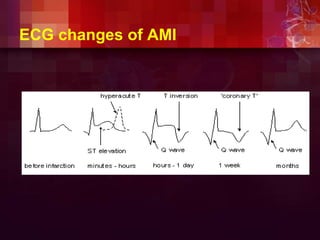 ECG changes of AMI
 