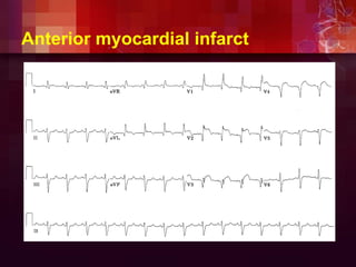 Anterior myocardial infarct
 