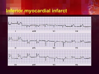 Inferior myocardial infarct
 