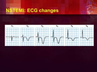 NSTEMI: ECG changes
 