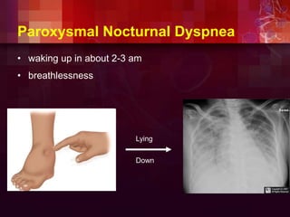 Paroxysmal Nocturnal Dyspnea
• waking up in about 2-3 am
• breathlessness
Lying
Down
 