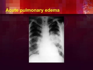 Acute pulmonary edema
 