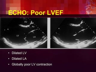 ECHO: Poor LVEF
• Dilated LV
• Dilated LA
• Globally poor LV contraction
 