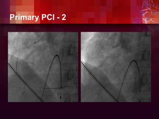 Primary PCI - 2
 