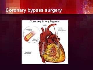 Coronary bypass surgery
 