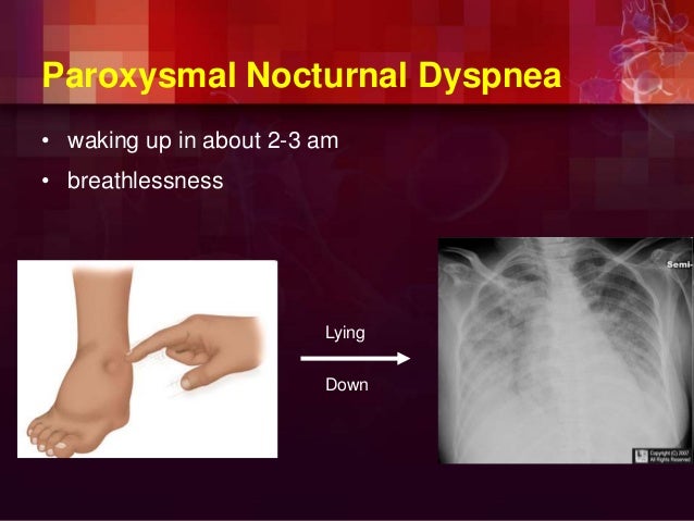 orthopnea paroxysmal nocturnal dyspnea orthopnea paroxysmal nocturnal dyspnea