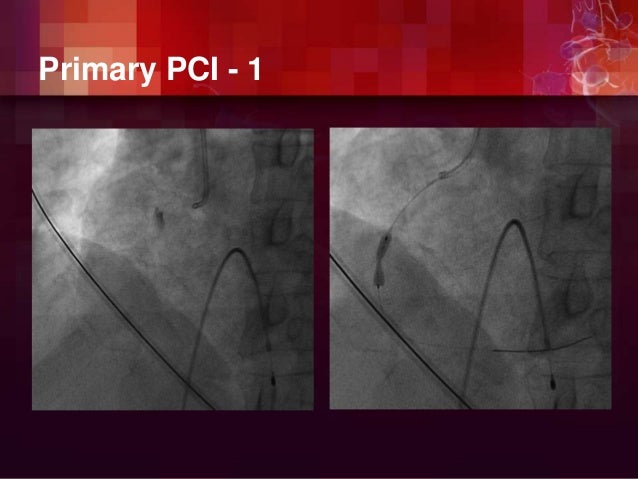 Ischemic Heart Disease