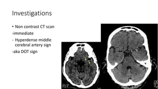 Investigations
• Non contrast CT scan
-immediate
- Hyperdense middle
cerebral artery sign
-aka DOT sign
 