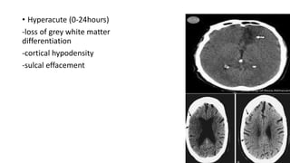 • Hyperacute (0-24hours)
-loss of grey white matter
differentiation
-cortical hypodensity
-sulcal effacement
 