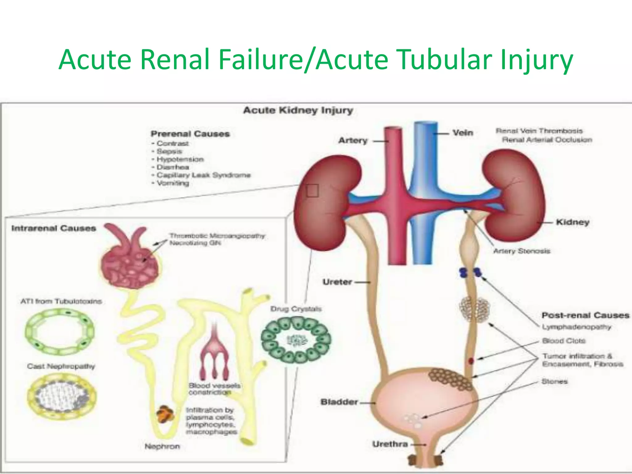 Ischemic and toxic renal injury and renal disease in pregnancy | PPTX ...